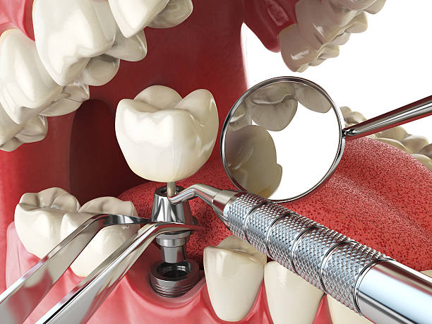Best Emergency Dental Care for Broken or Chipped Teeth in Benton, LA